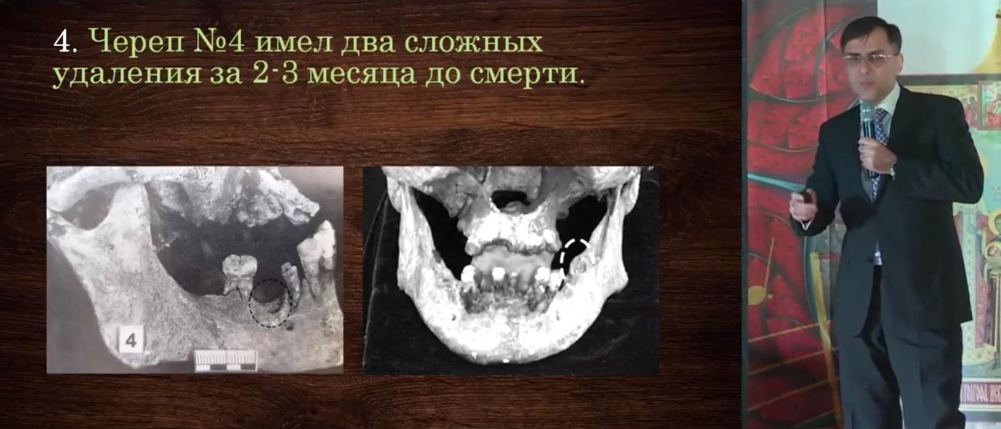Комплексное историко-стоматологическое исследование (экспертиза) показало, что черепа из «екатеринбургских останков» не могут принадлежать членам Царской семьи